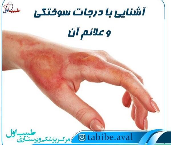 عکس های سوختگی دست