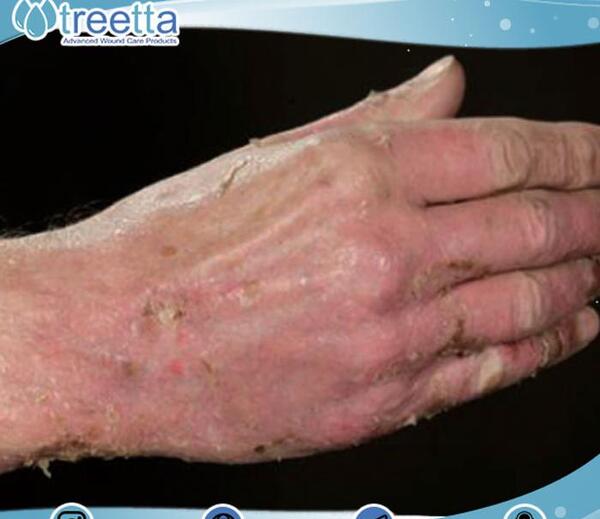 عکس های سوختگی دست