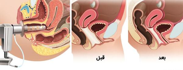 عکس دستگاه لیزر مونالیزا