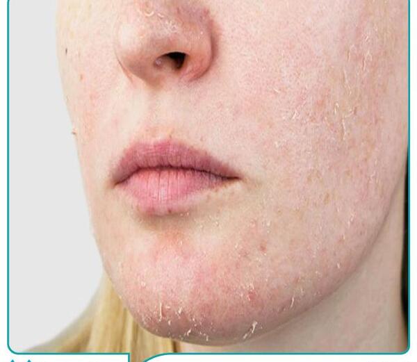 عکس ابله میمون چگونه است