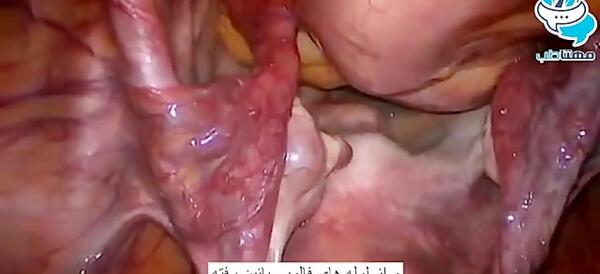 عکس آزاد شدن تخمک
