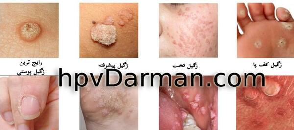 عکس زگیل تناسلی در زنان