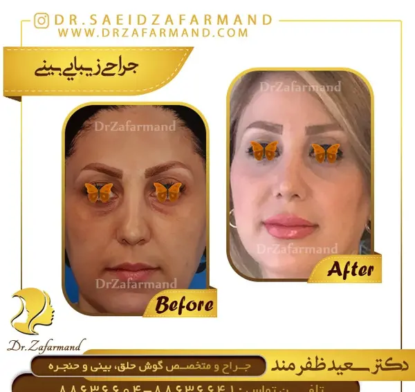 عکس بهار ارجمند قبل از عمل بینی