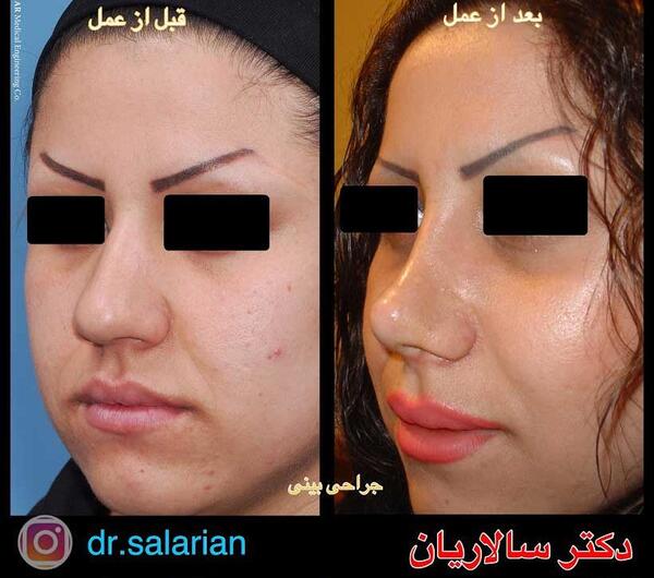 عکس بهار ارجمند قبل از عمل بینی