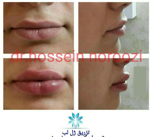 عکس روز اول ژل لب