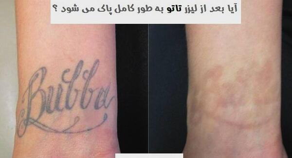 عکس لیزر تاتو دست