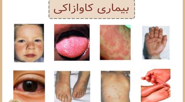 عکس جوش کرونا