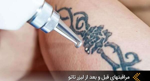 عکس لیزر تاتوی دست