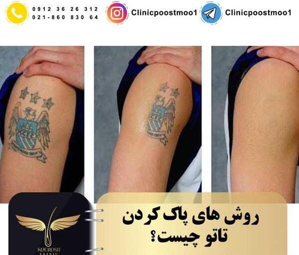 عکس لیزر تاتوی دست