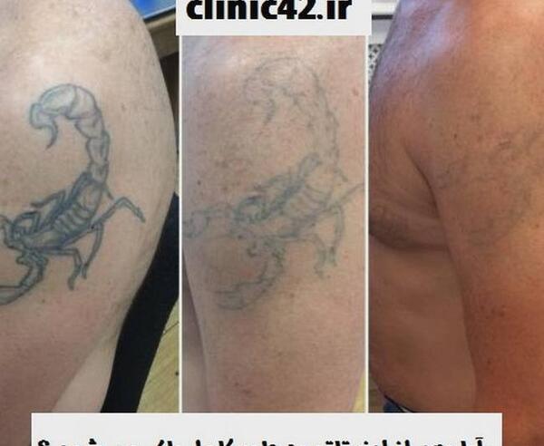 عکس لیزر تاتوی دست