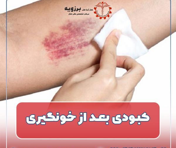 سرم عکس کبودی دست دختر