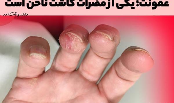 عکس مدل کاشت ناخن شست پا