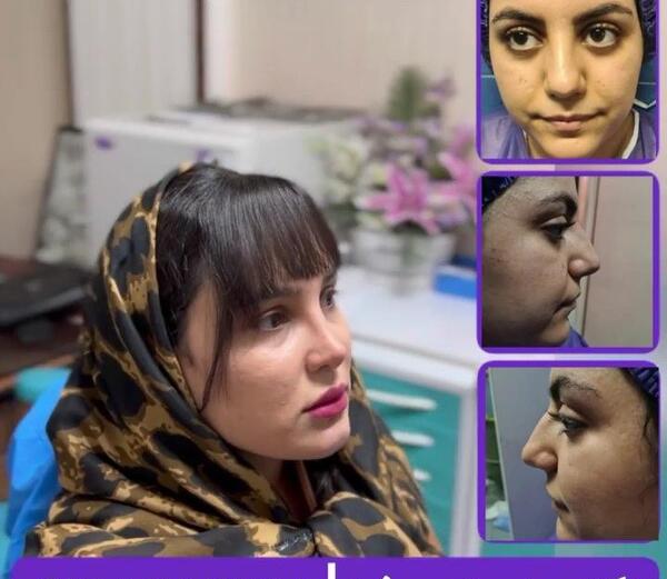 عکس نیوشا ضیغمی قبل از عمل جراحی بینی