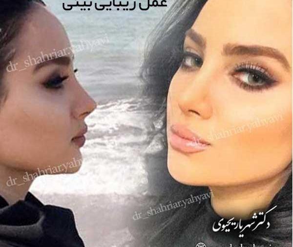 عکس نیوشا ضیغمی قبل از عمل جراحی بینی