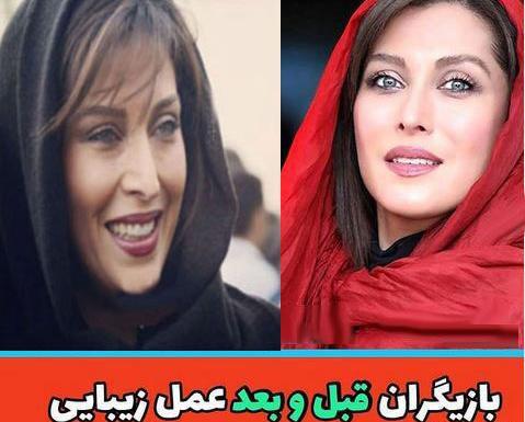 عکس نیوشا ضیغمی قبل از عمل جراحی بینی