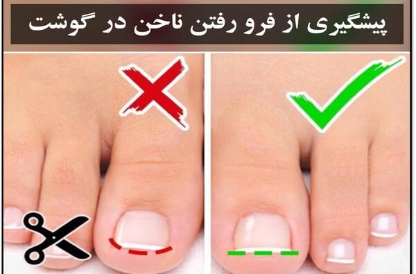 عکس تاول کرونا
