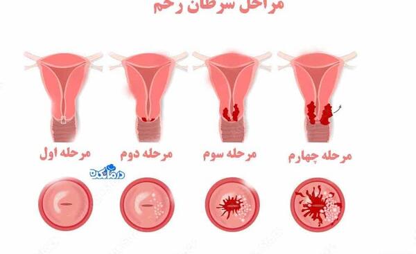 عکس واقعی عفونت قارچی واژن