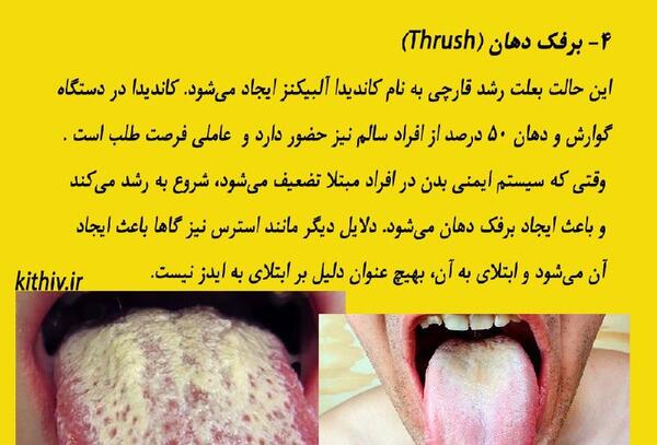 عکس واقعی عفونت قارچی واژن
