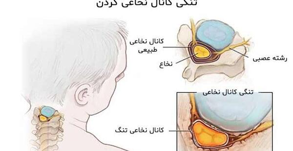 عکس ورزش آرتروز گردن