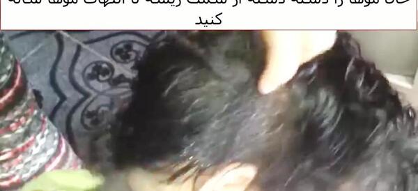 عکس شپش سر نوزاد