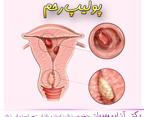 عکس ضخیم شدن دیواره رحم