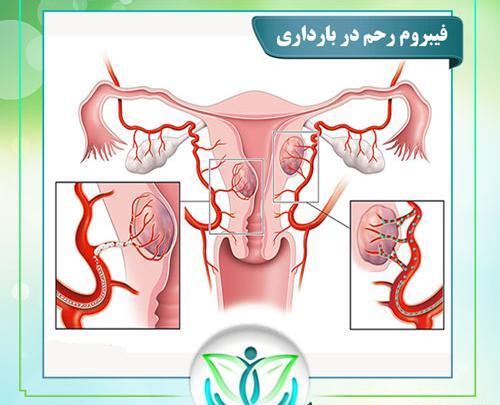 عکس ضخیم شدن دیواره رحم