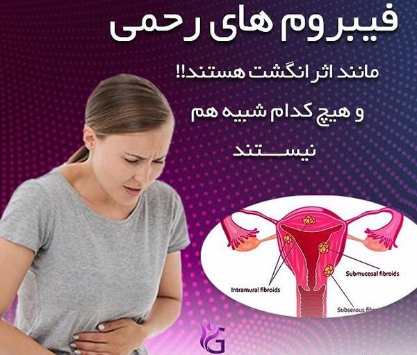 عکس ضخیم شدن دیواره رحم