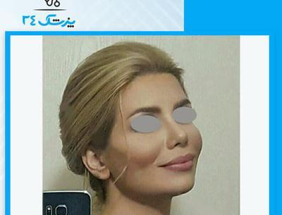 عکس نیوشا ضیغمی بعد از عمل بینی