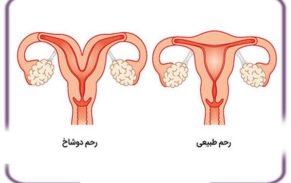 عکس بارداری خارج از رحم