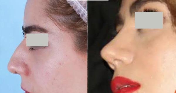 عکس نگین روی دماغ