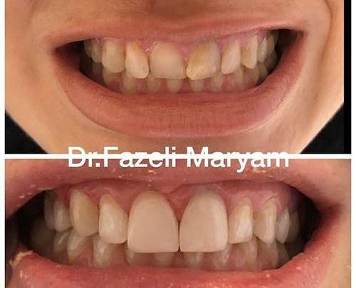 عکس نگین های ارتودنسی