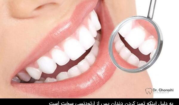 عکس نگین های ارتودنسی