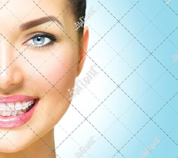 عکس نگین های ارتودنسی