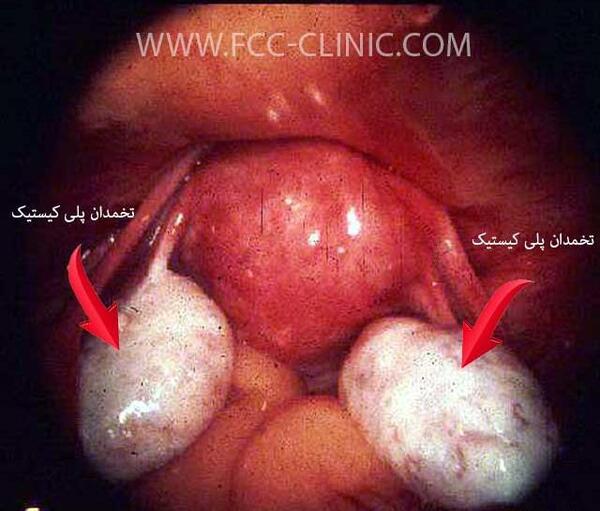 عکس واقعی تخمدان