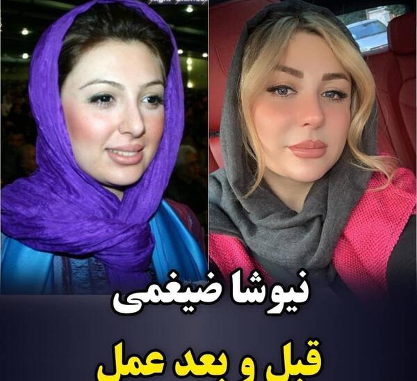 عکس نیوشا ضیغمی قبل عمل