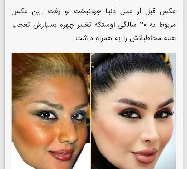 عکس های قبل عمل دنیا جهانبخت