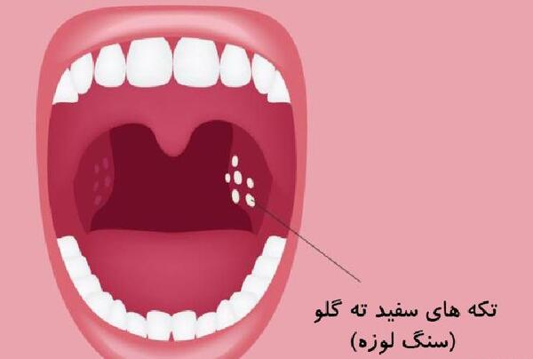 عکس لکه سفید روی لوزه