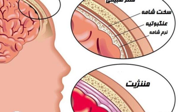 عکس های بیماری مننژیت