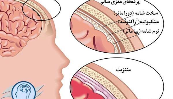 عکس های بیماری مننژیت