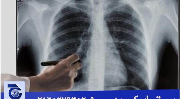 کیا عکس ریه گرفتن