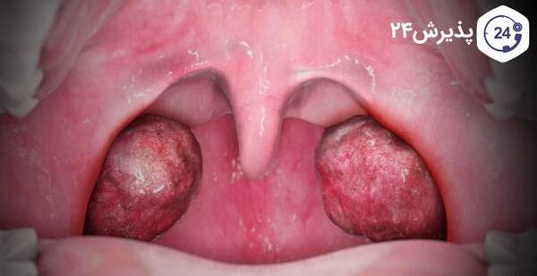 عکس گلو درد کرونا
