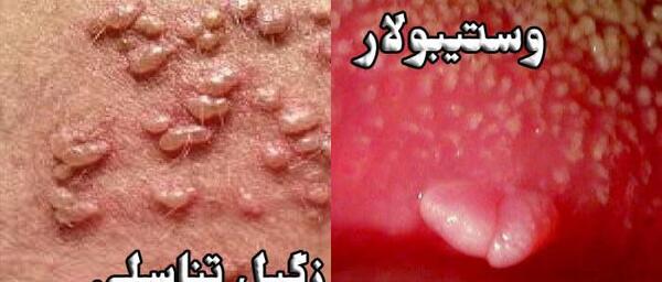 عکس واقعی عفونت قارچی واژن نی نی سایت