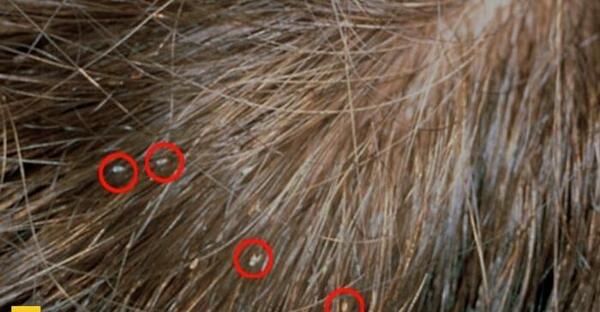 عکس بچه شپش در سر