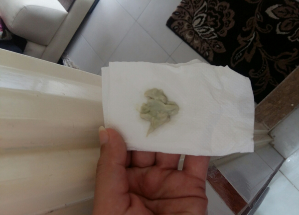 عکس ترشحات سبز رنگ واژن
