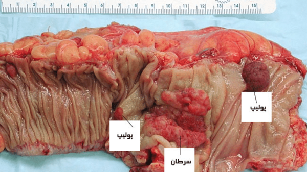 عکس روده بزرگ