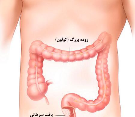 عکس روده بزرگ