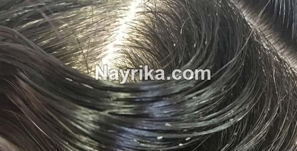عکس واضح شپش سر