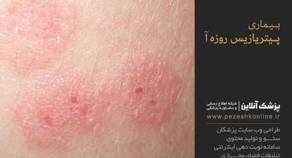 عکس بیماری پیتریازیس روزه آ