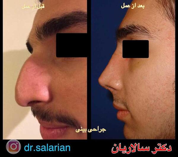 عکس گلزار قبل از عمل