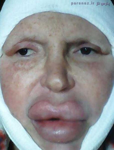 عکس عمل ترنس
